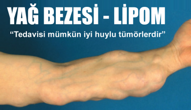 Lipom