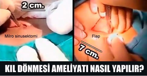 Kıl dönmesi tedavisi için uygulanan yöntemler