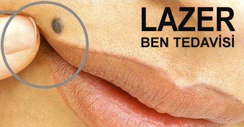 Lazerle ben aldırma nasıl yapılır