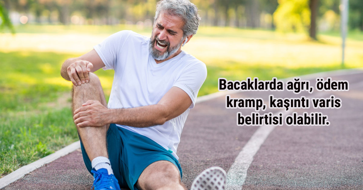 Varis Hastalığı Belirtileri, Nedenleri ve Çözüm Önerisi idea klinik