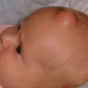 Bebeklerin kafasında şişlikk