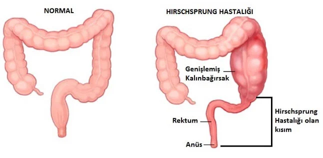 Kalınbağırsak genişlemesi