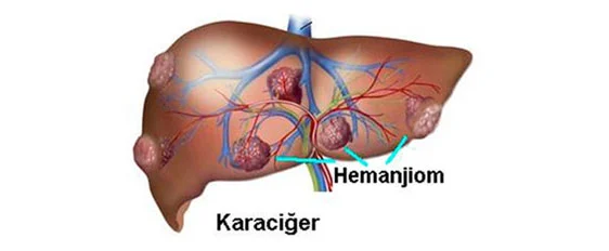 İç organlarda hemanjiom