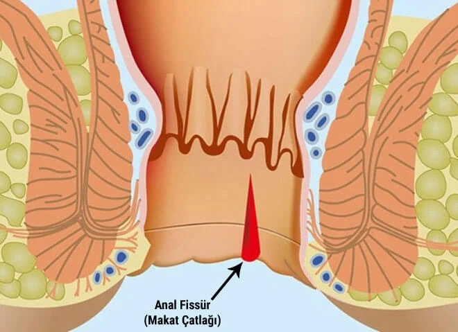 Anal fissür