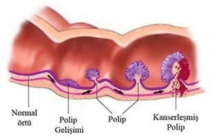 Polip zararlı mı