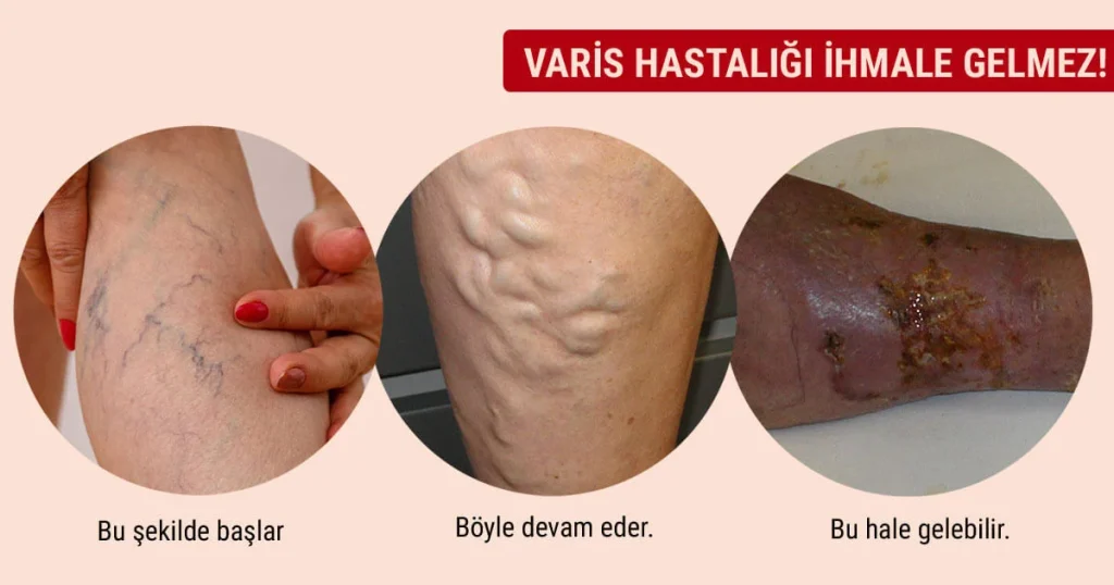 Varis hastalığı nedir